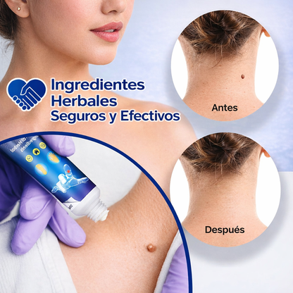 Tratamiento para Verrugas (Wart Remover)