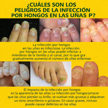 ESENCIA ANTIHONGOS PARA UÑAS BLUE CHIC L
